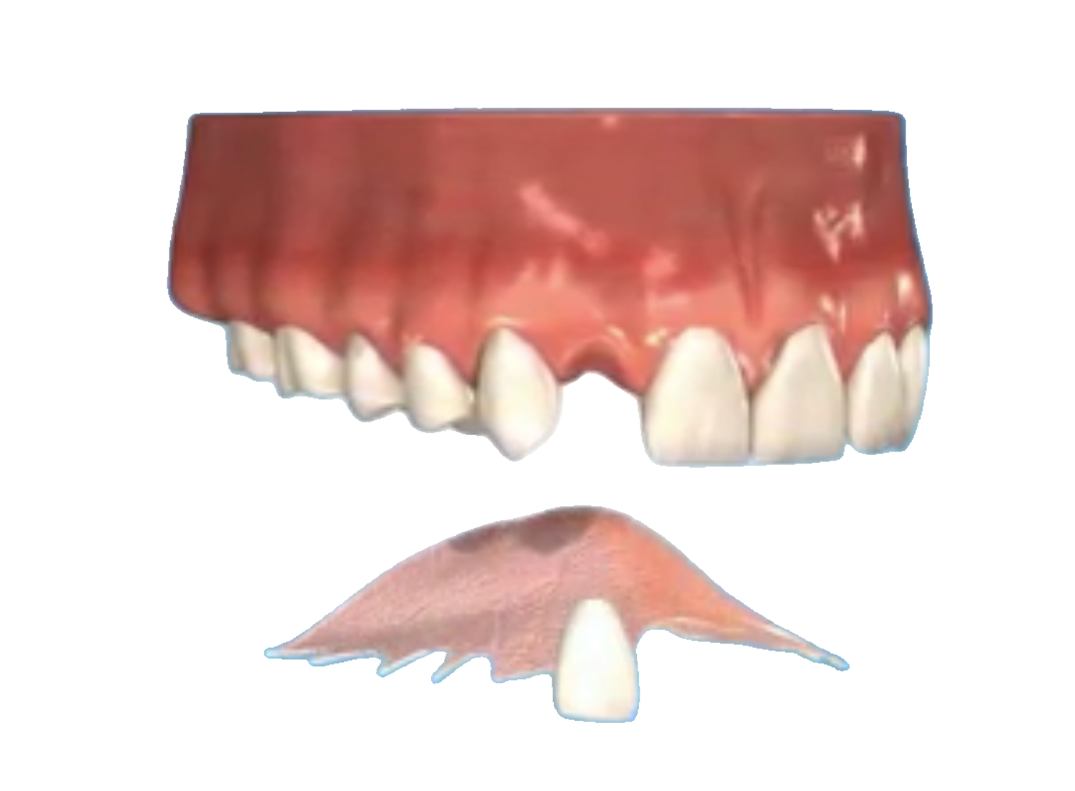 Missing tooth-Denture- Johannesburg